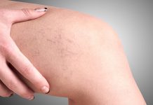 10 remedii naturale pentru tratarea varicelor