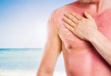 7 remedii naturale pentru arsurile solare