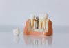Cât costă un implant dentar? De la șurubul din titan la dintele complet