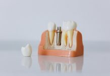 Cât costă un implant dentar? De la șurubul din titan la dintele complet