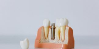 Cât costă un implant dentar? De la șurubul din titan la dintele complet